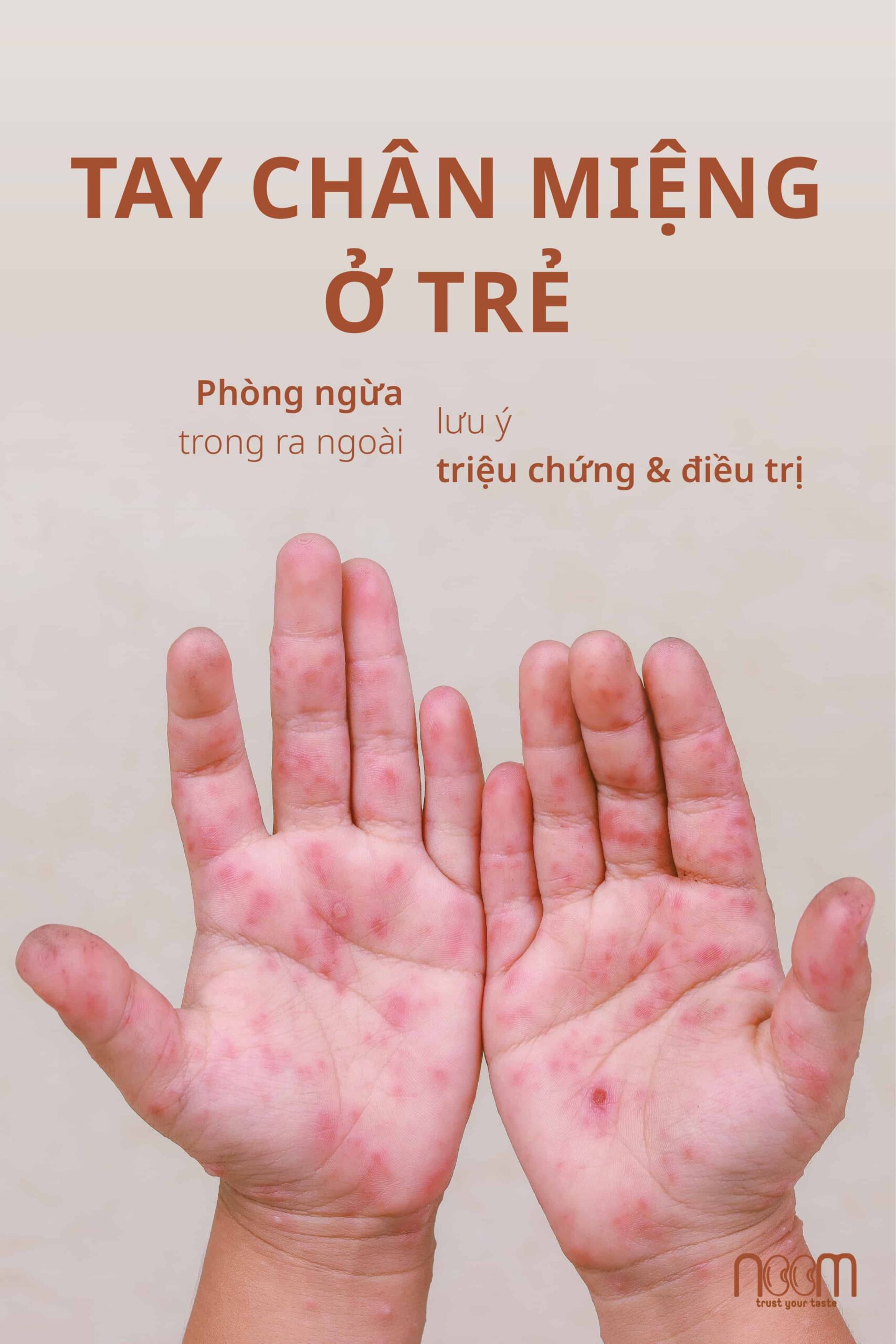 bệnh tay chân miệng ở trẻ