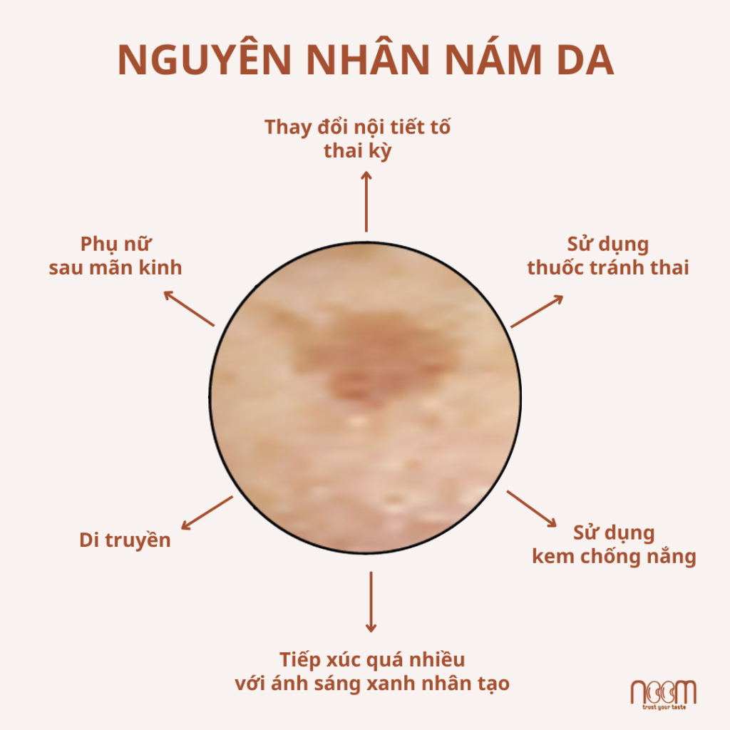 Nguyên nhân gây nám da